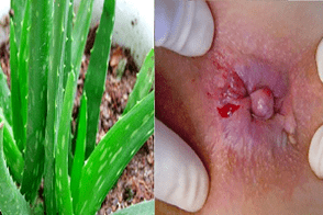 الصبار لعلاج البواسير