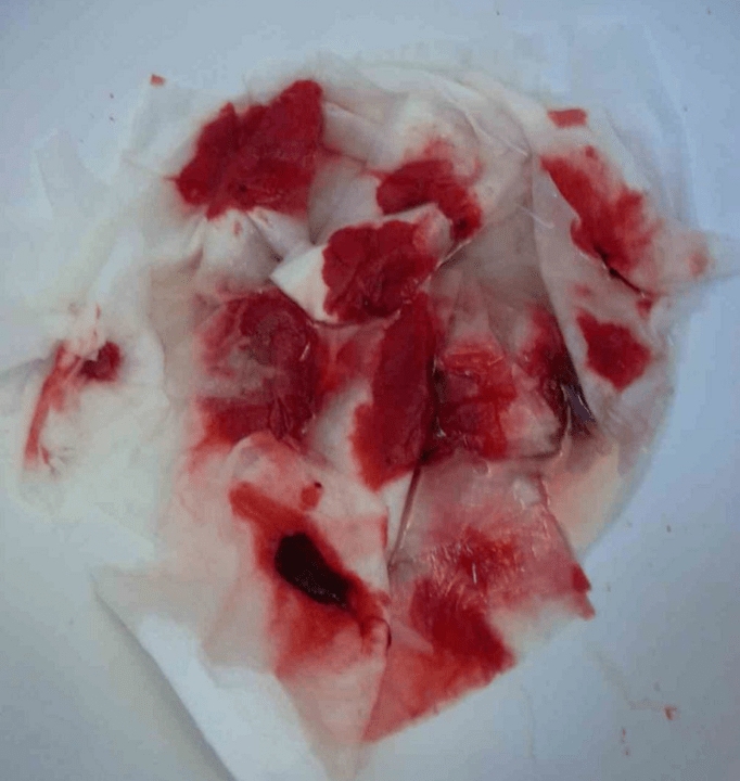 نزيف مع البواسير