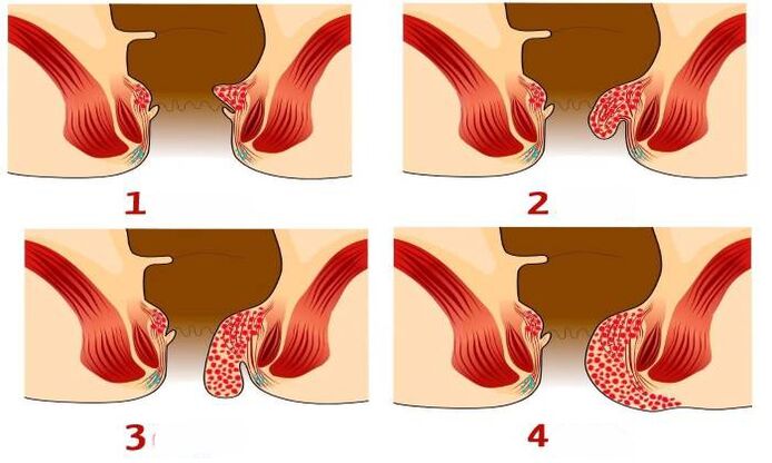 كيف تبدو البواسير في مراحل مختلفة