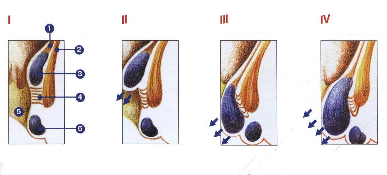 مراحل تطور البواسير